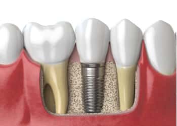 bone graft for dental implant bella vista