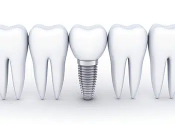 dental implants bella vista