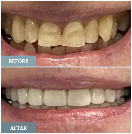 Stacey Veneers ab