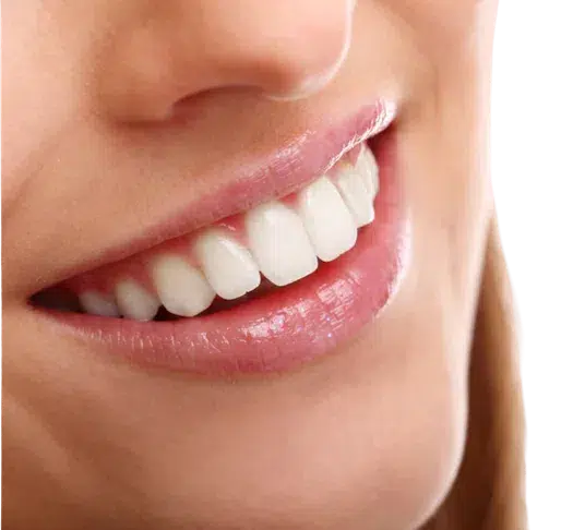 cosmetic veneers sec