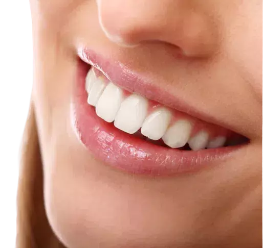 dent veneers