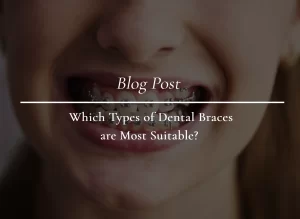 Types of Dental Braces